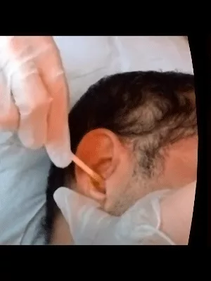 Depilação orelha