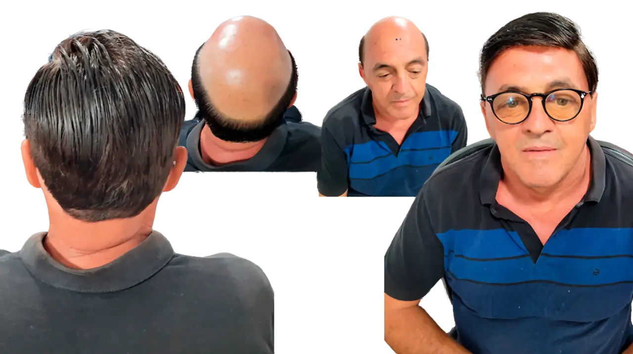 Prótese Capilar (imagem)
